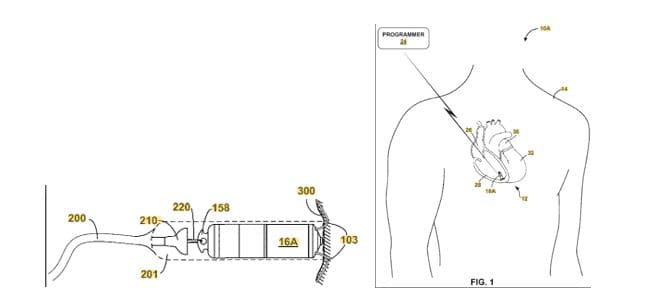 Today’s Patent – Implantable Medical Device Fixation