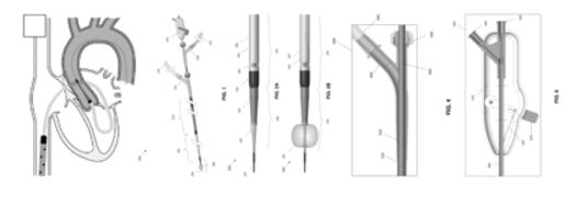 Today’s Patent – Method and Apparatus for Catheter-Based Extracorporeal Membrane Oxygenation (ECMO)