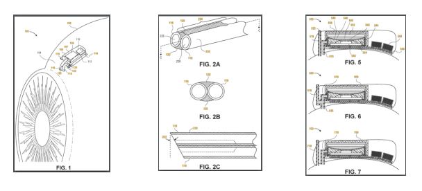 Today’s Patent – Implantable Extracompartmental pressure sensor